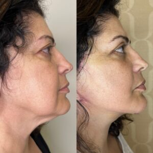 Resultado de cirurgia bucomaxilofacial