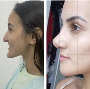 Pré e pós-operatório de mentoplastia e rinoplastia